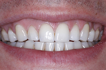 Brilliant white smile after cosmetic dentistry