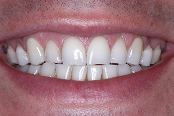 Discolored teeth before cosmetic dentistry