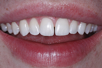 Gap between front teeth