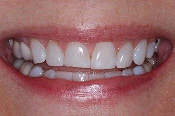 Chipped tooth before cosmetic dental bonding