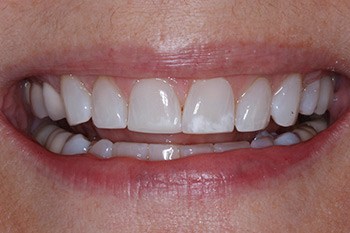 Beautiful smile after cosmetic dental bonding