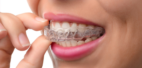 Woman inserting invisalign tray