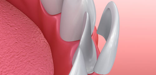 Animation of placing porcelain veneers on teeth
