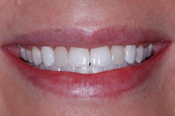 Discolored front teeth before porcelain veneer placement