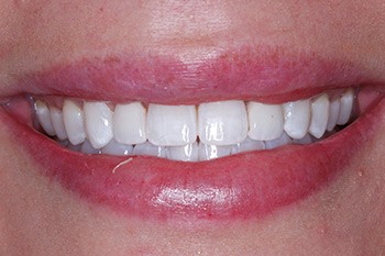 Perfect smile after porcelain veneer placement